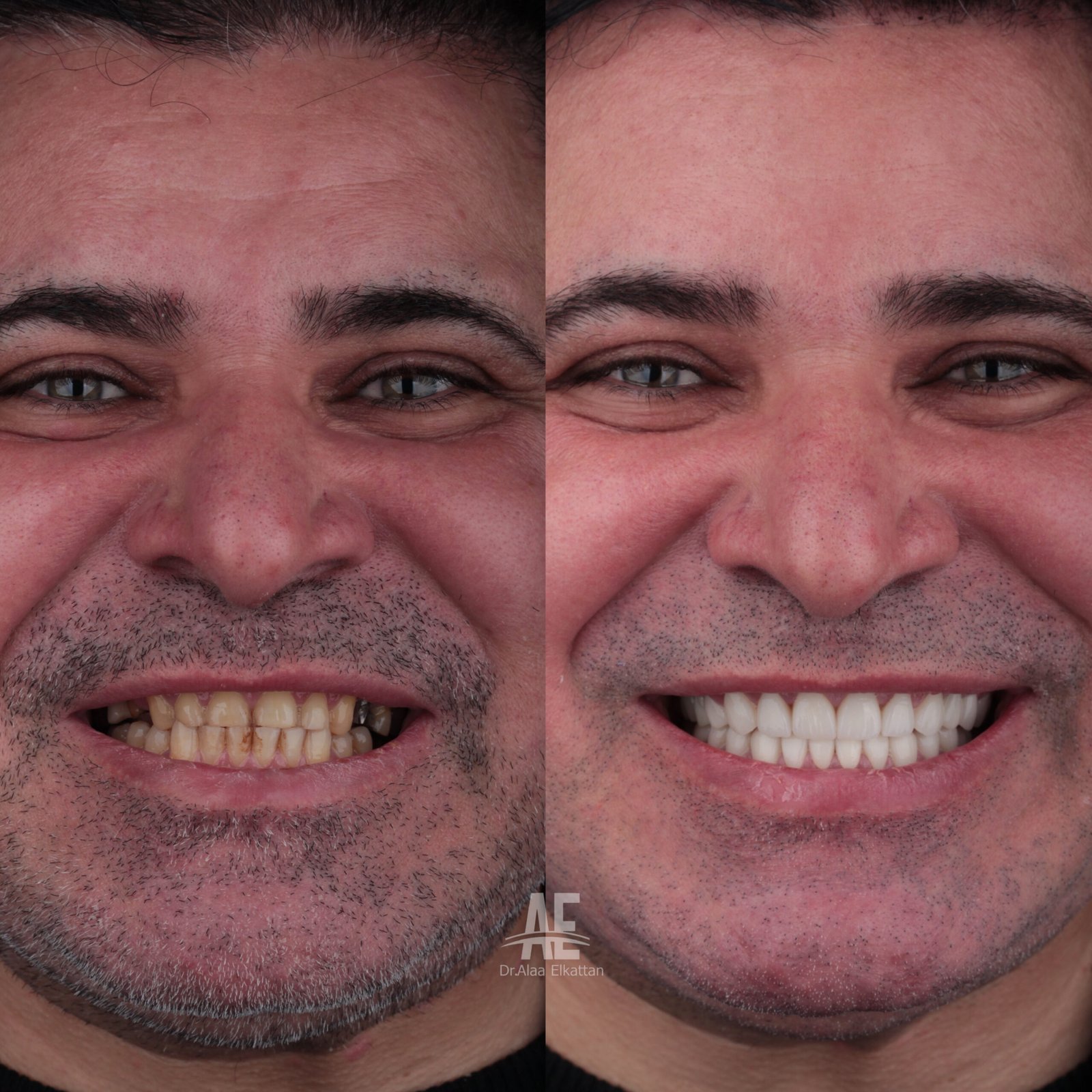 حالة موثقة 9 - Royal Dental Center