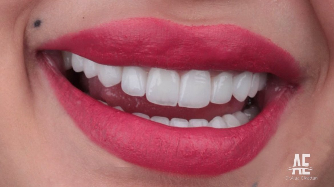 حالة موثقة 24 - Royal Dental Center