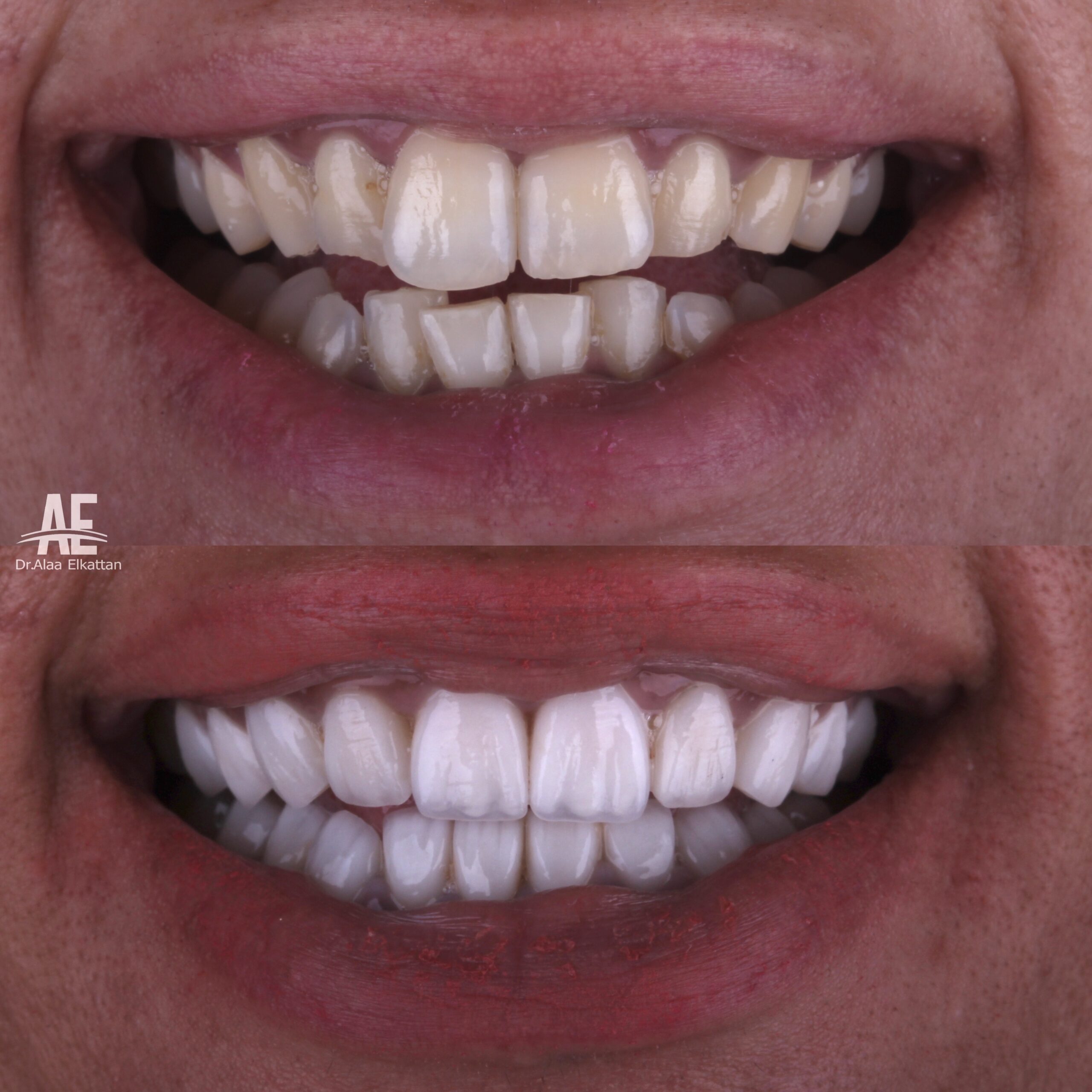 حالة موثقة 50 - Royal Dental Center
