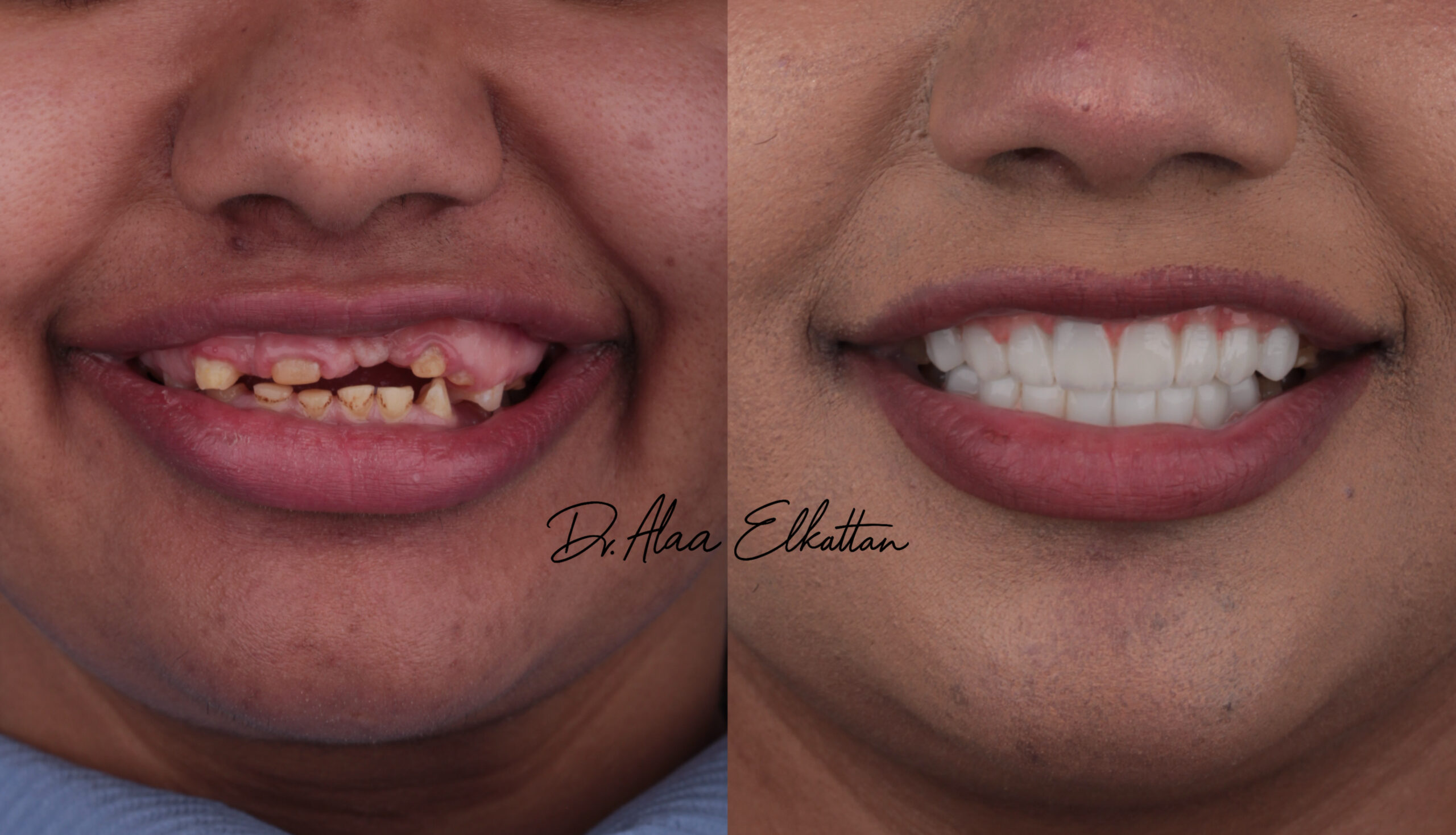 حالة موثقة 16 - Royal Dental Center