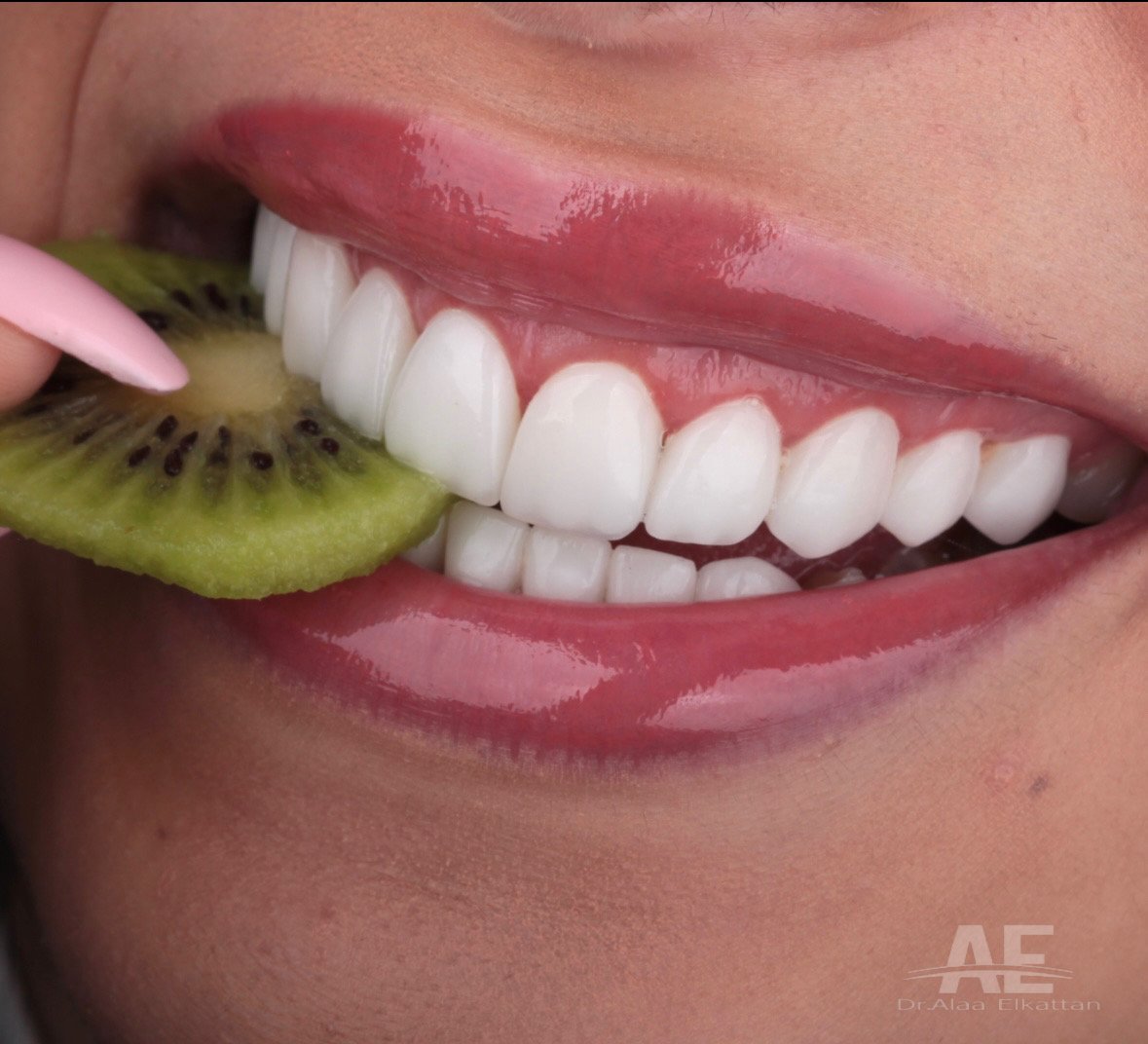 حالة فينير وابتسامة هوليوود 71 - د. علاء القطان