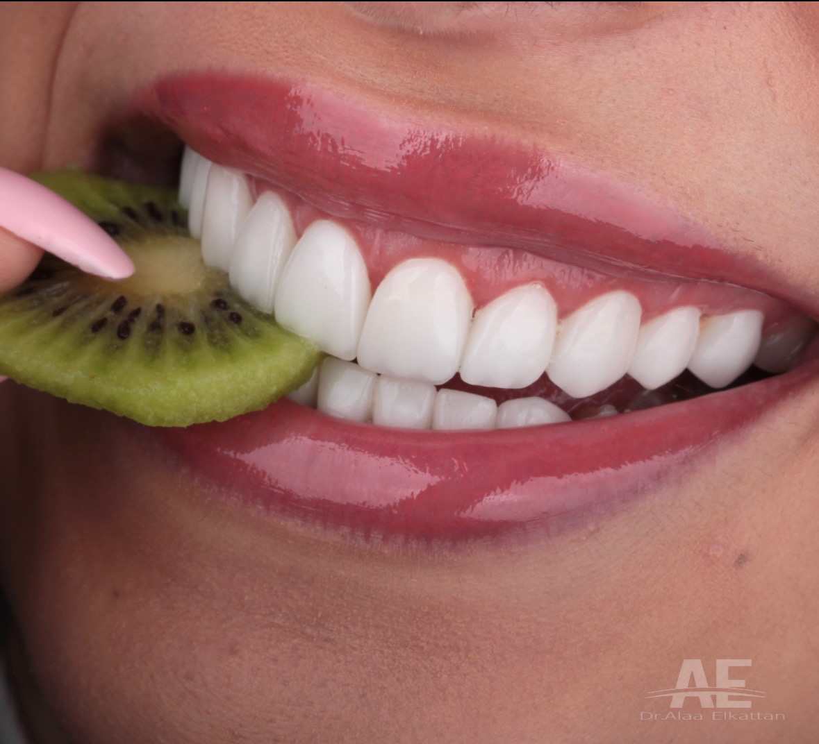 حالة موثقة 9 - Royal Dental Center