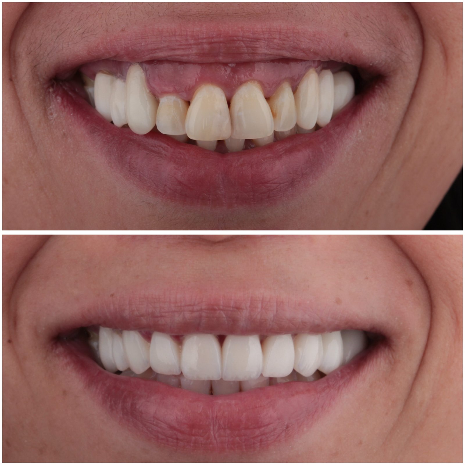 حالة موثقة 14 - Royal Dental Center