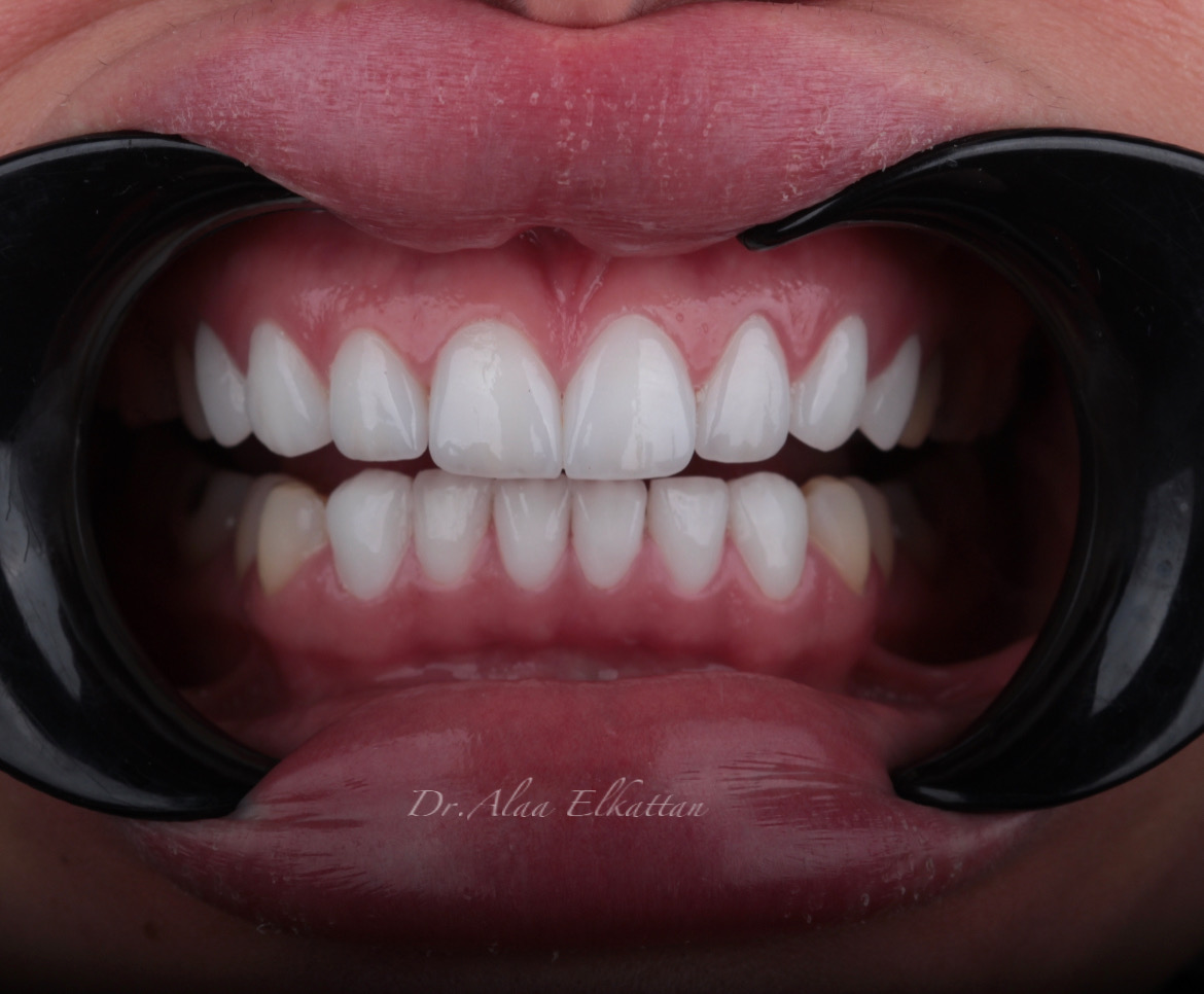 حالة موثقة 6 - Royal Dental Center