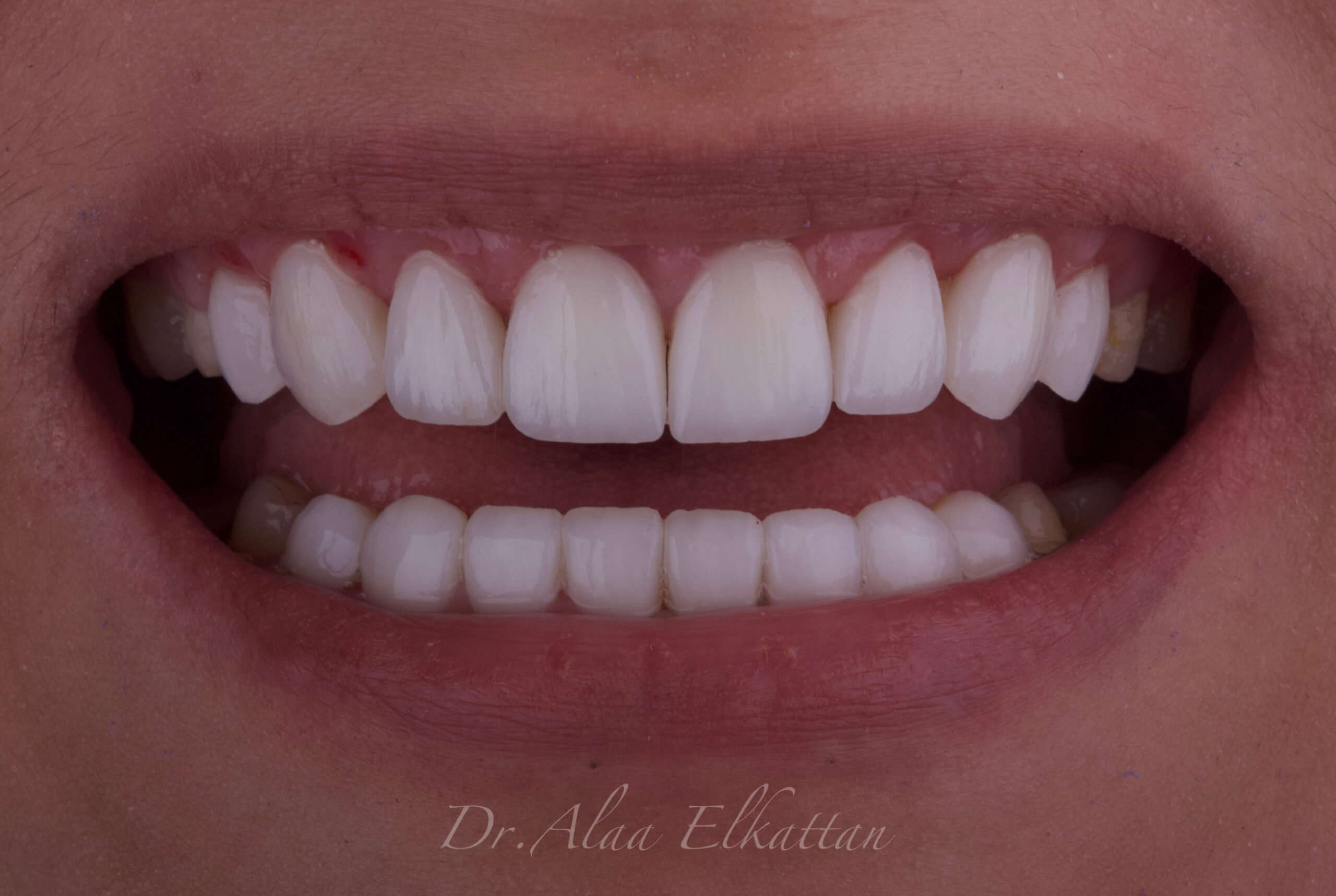 حالة موثقة 15 - Royal Dental Center