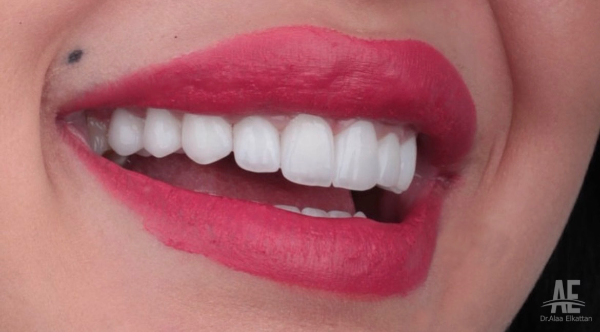 حالة موثقة 2 - Royal Dental Center