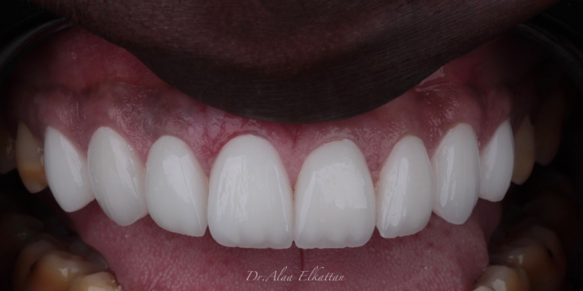 حالة موثقة 1 - Royal Dental Center