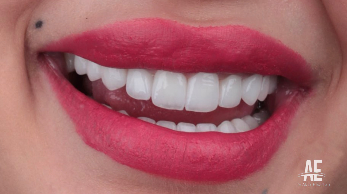 حالة موثقة 3 - Royal Dental Center