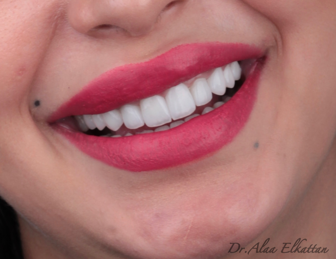 حالة موثقة 8 - Royal Dental Center