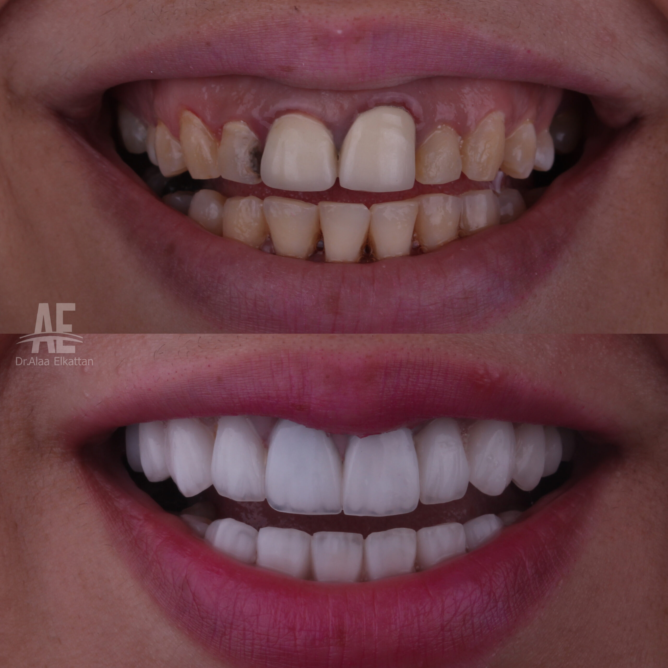 حالة موثقة 40 - Royal Dental Center