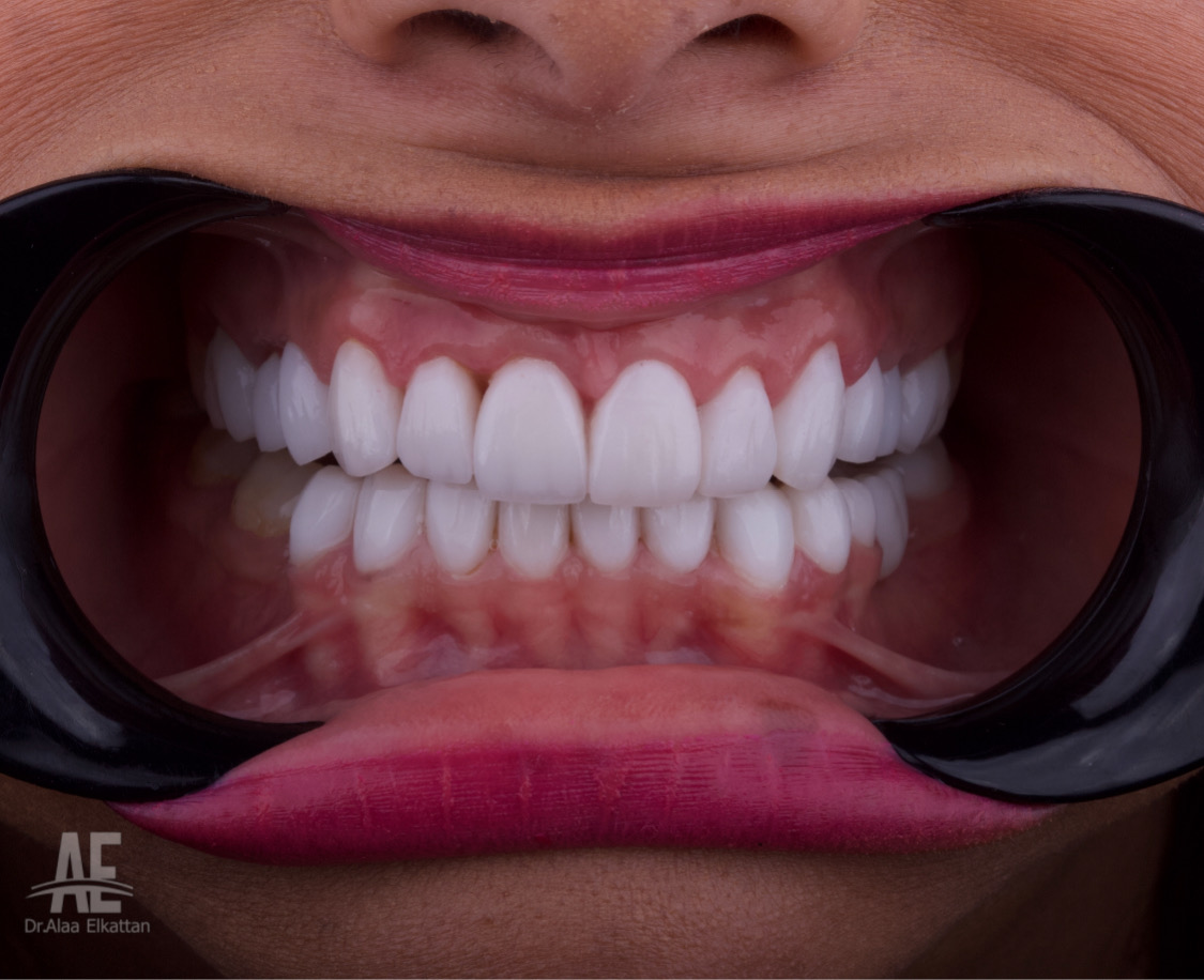 حالة موثقة 7 - Royal Dental Center