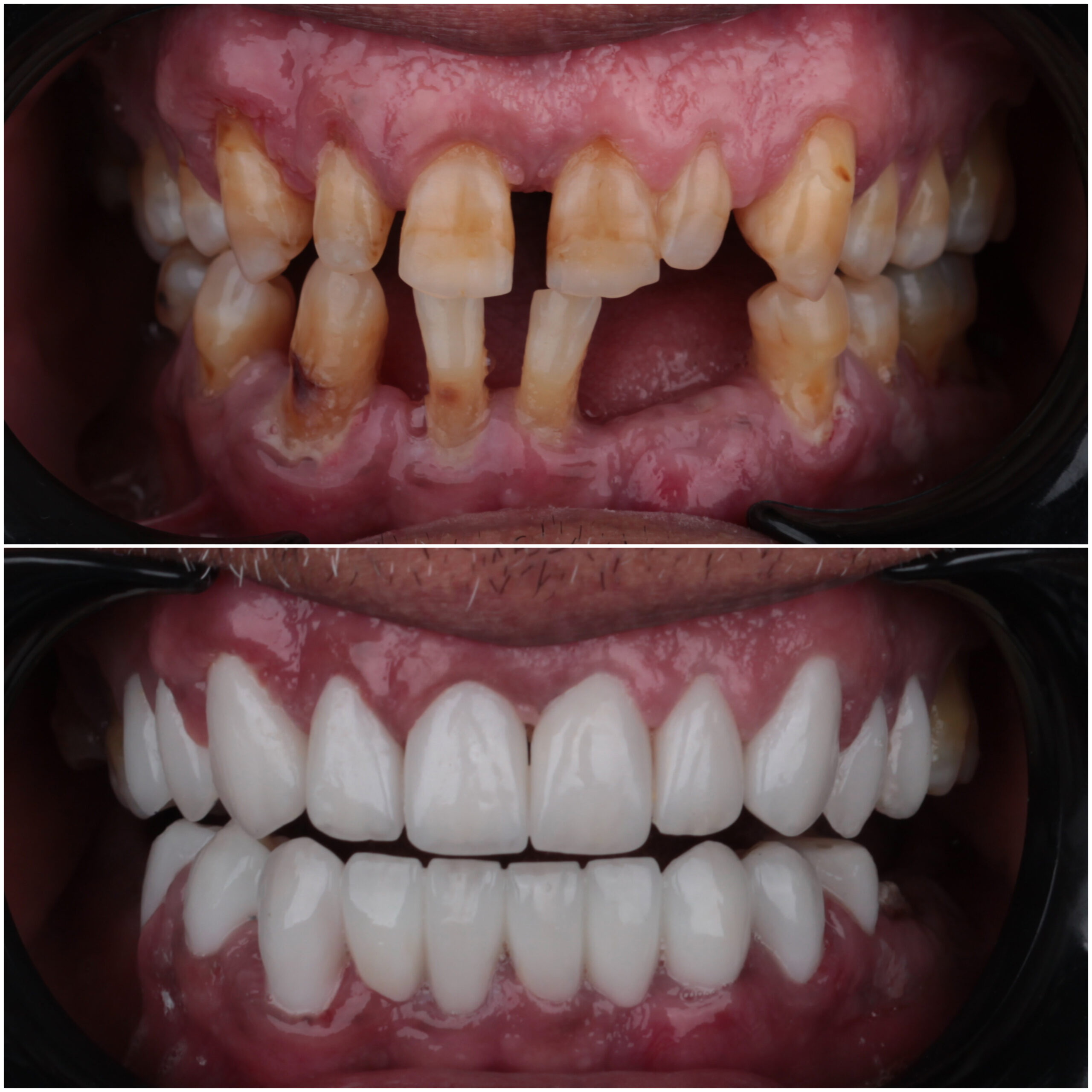 حالة موثقة 26 - Royal Dental Center