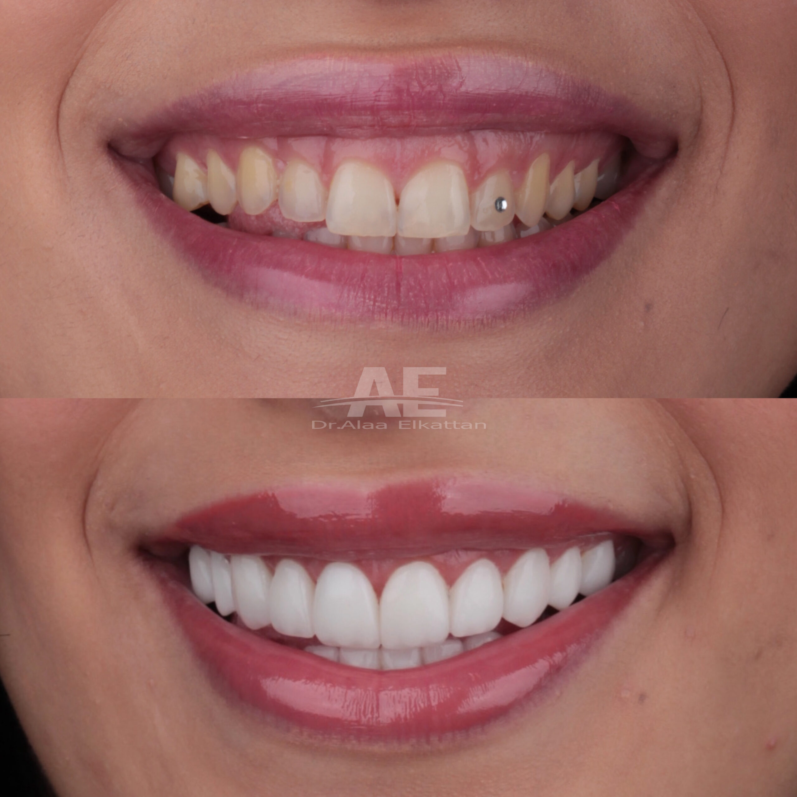 حالة موثقة 25 - Royal Dental Center
