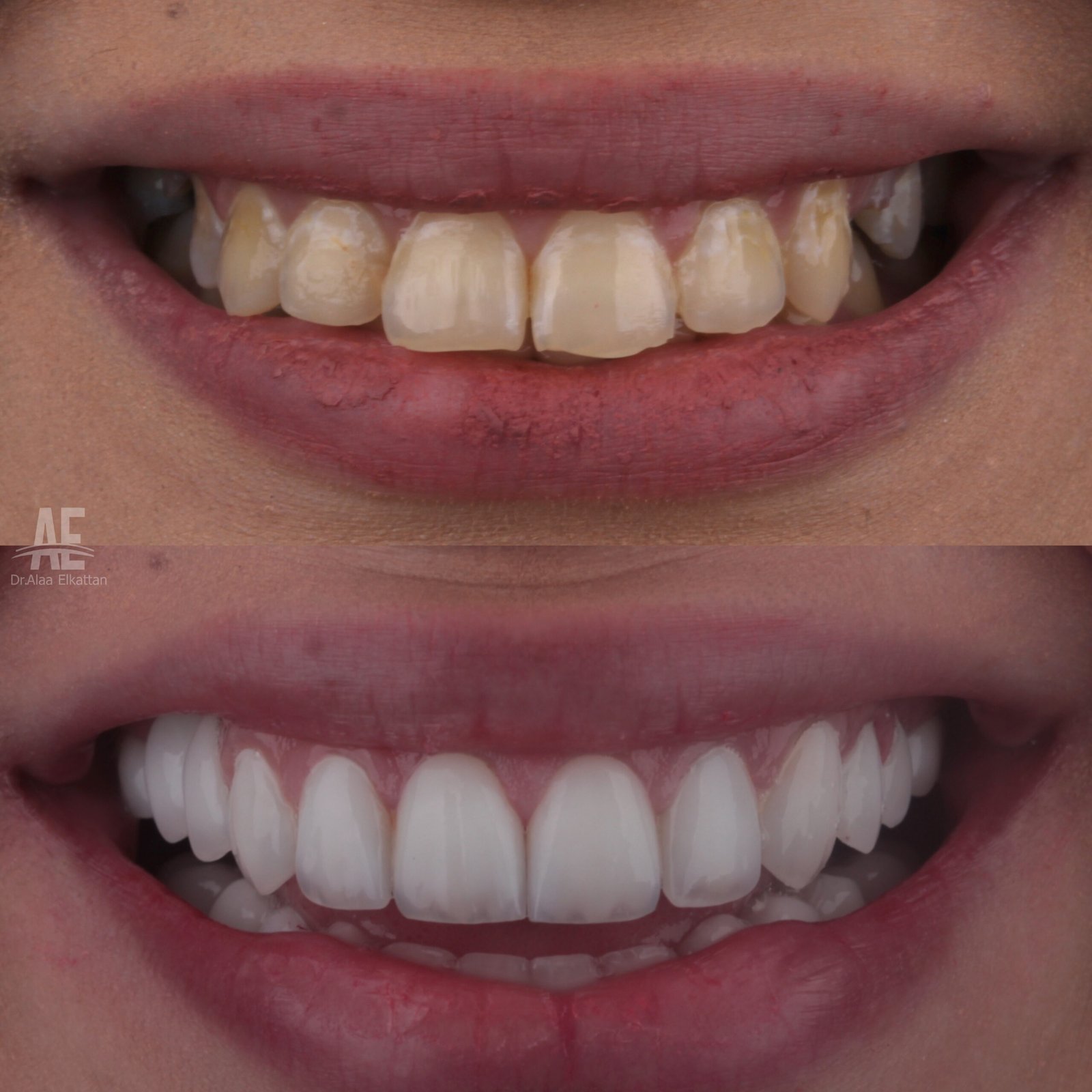 حالة موثقة 15 - Royal Dental Center