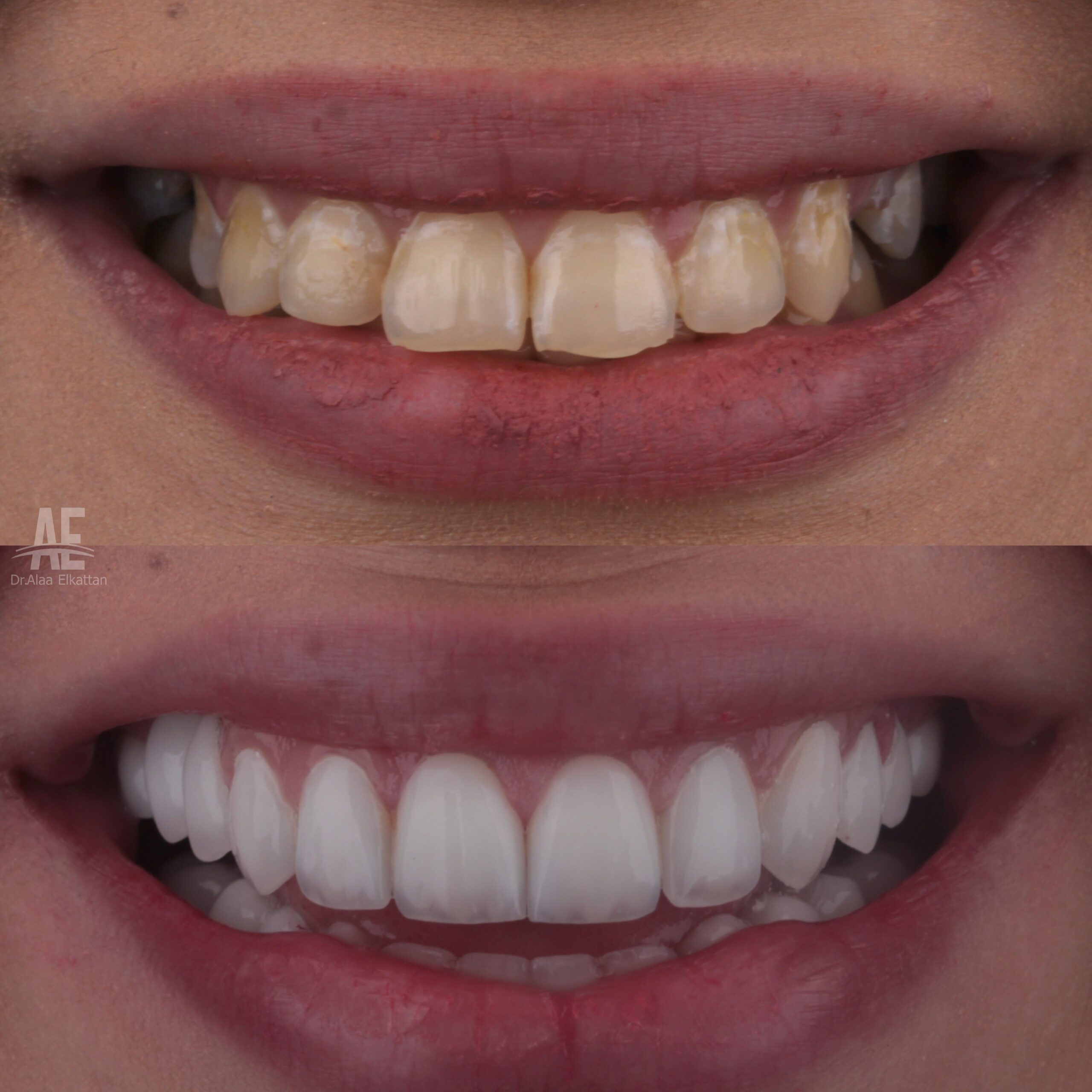 حالة موثقة 43 - Royal Dental Center