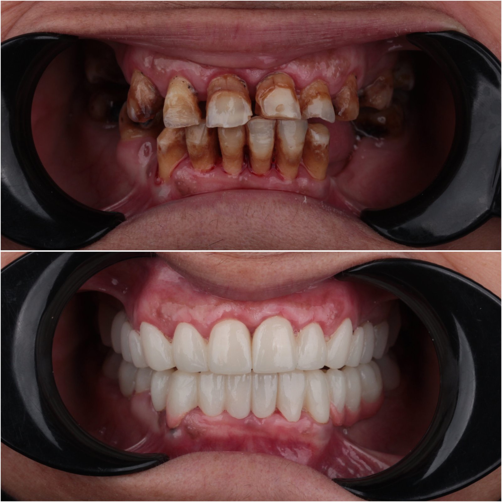 حالة موثقة 13 - Royal Dental Center