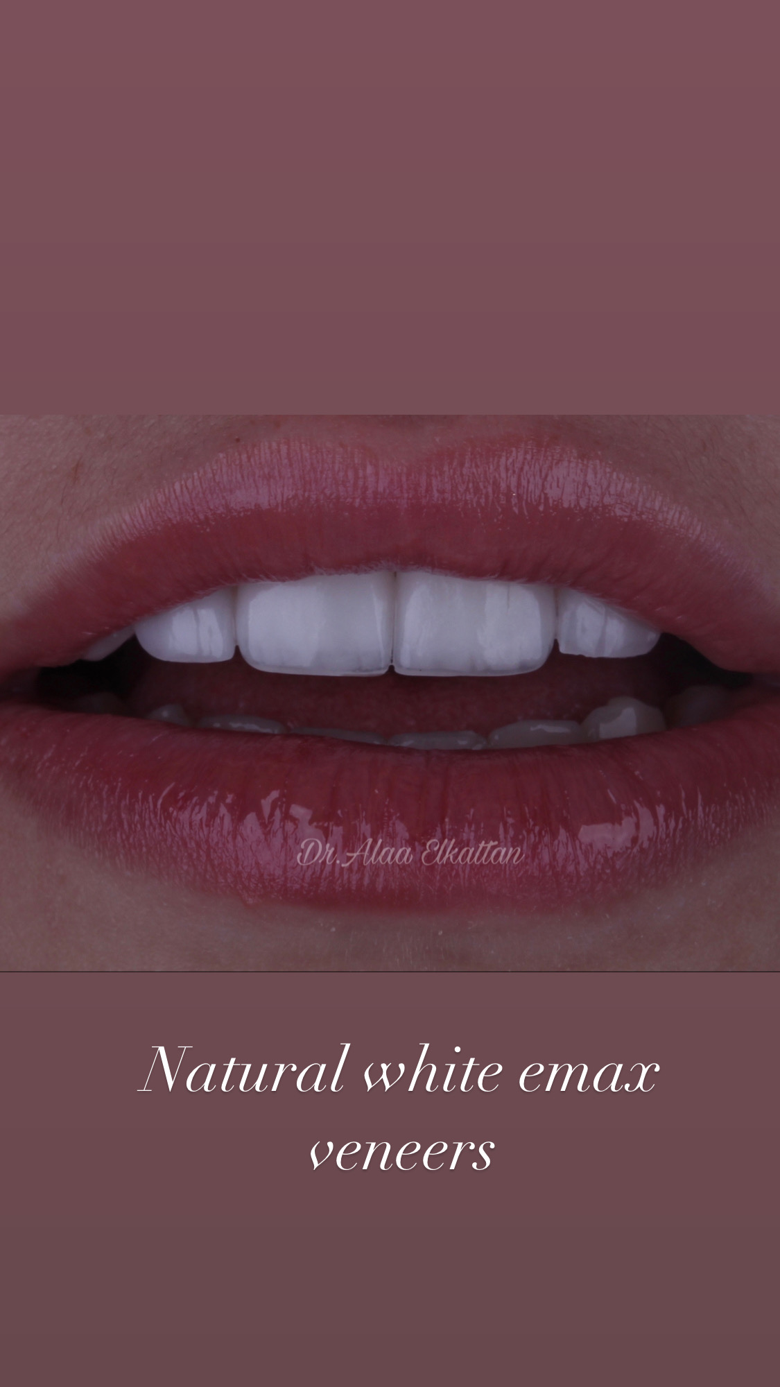 حالة موثقة 10 - Royal Dental Center