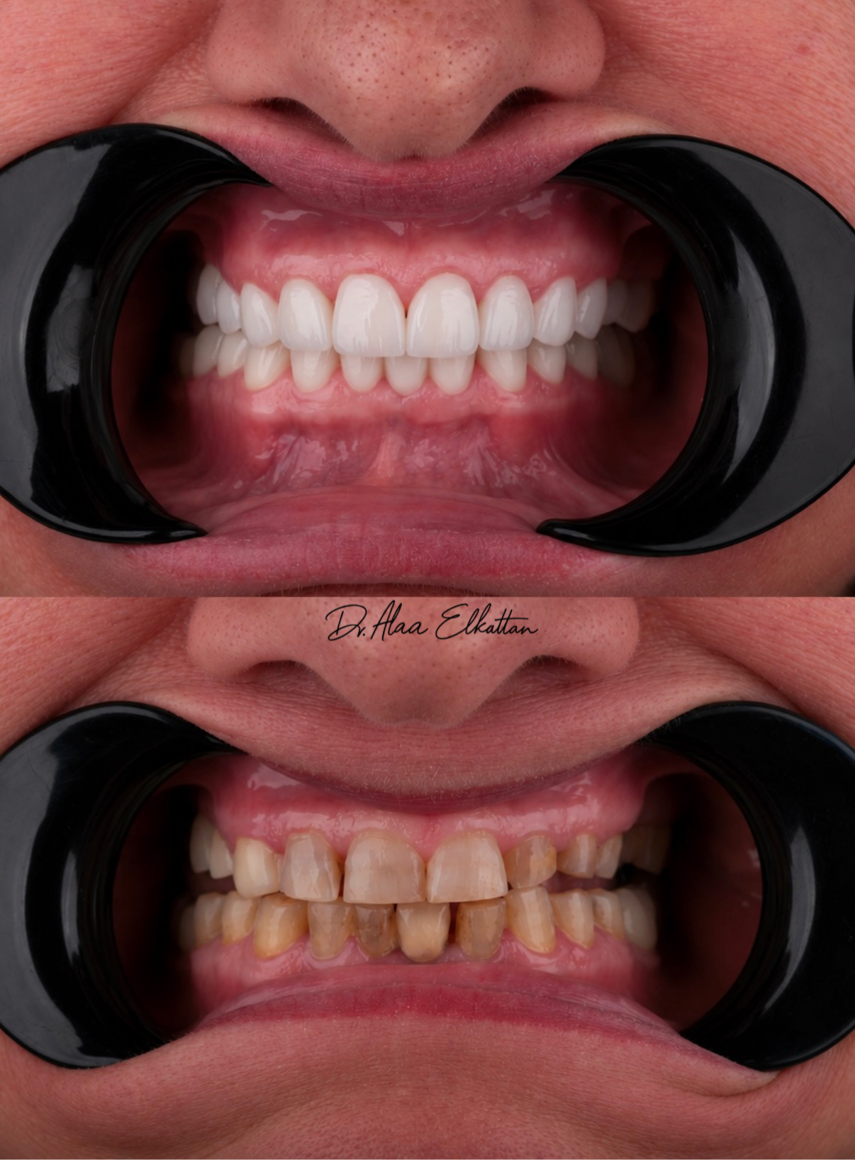 حالة موثقة 13 - Royal Dental Center