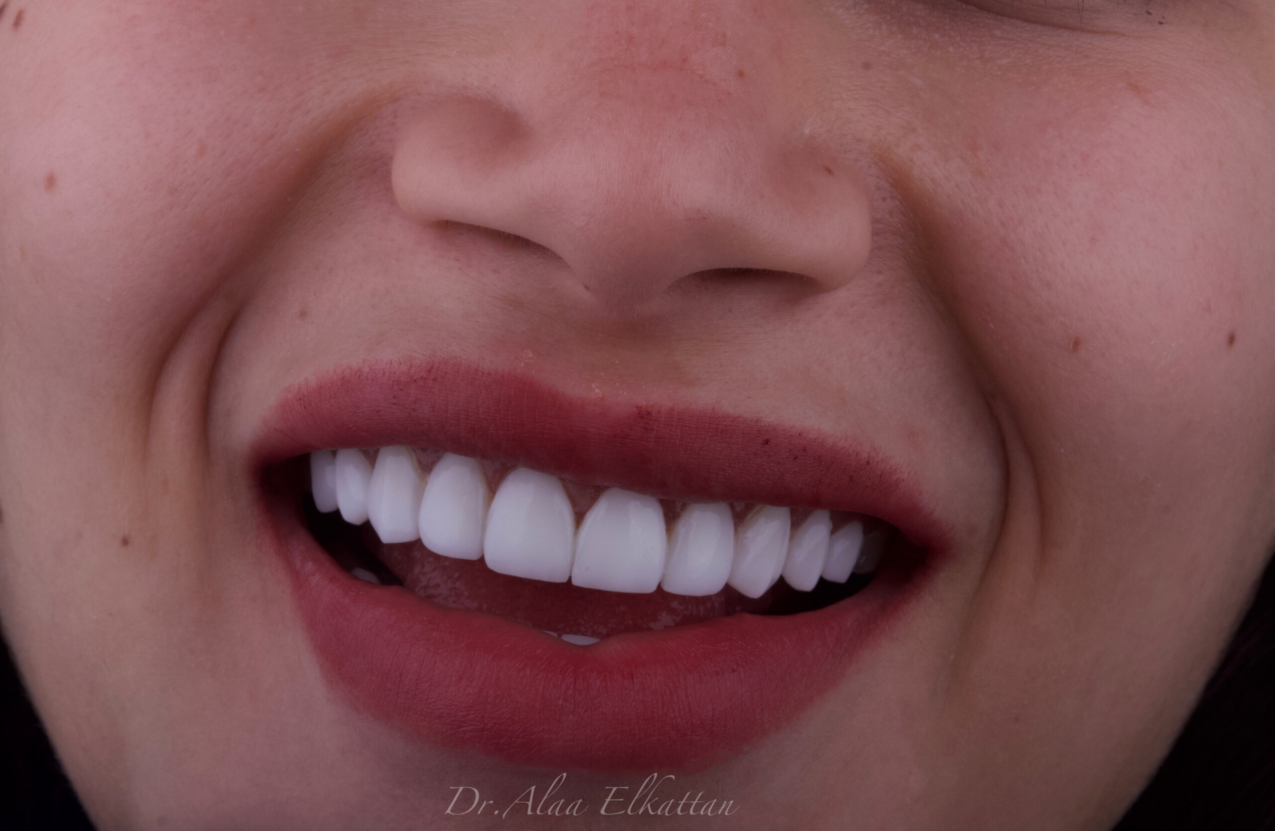 حالة موثقة 56 - Royal Dental Center