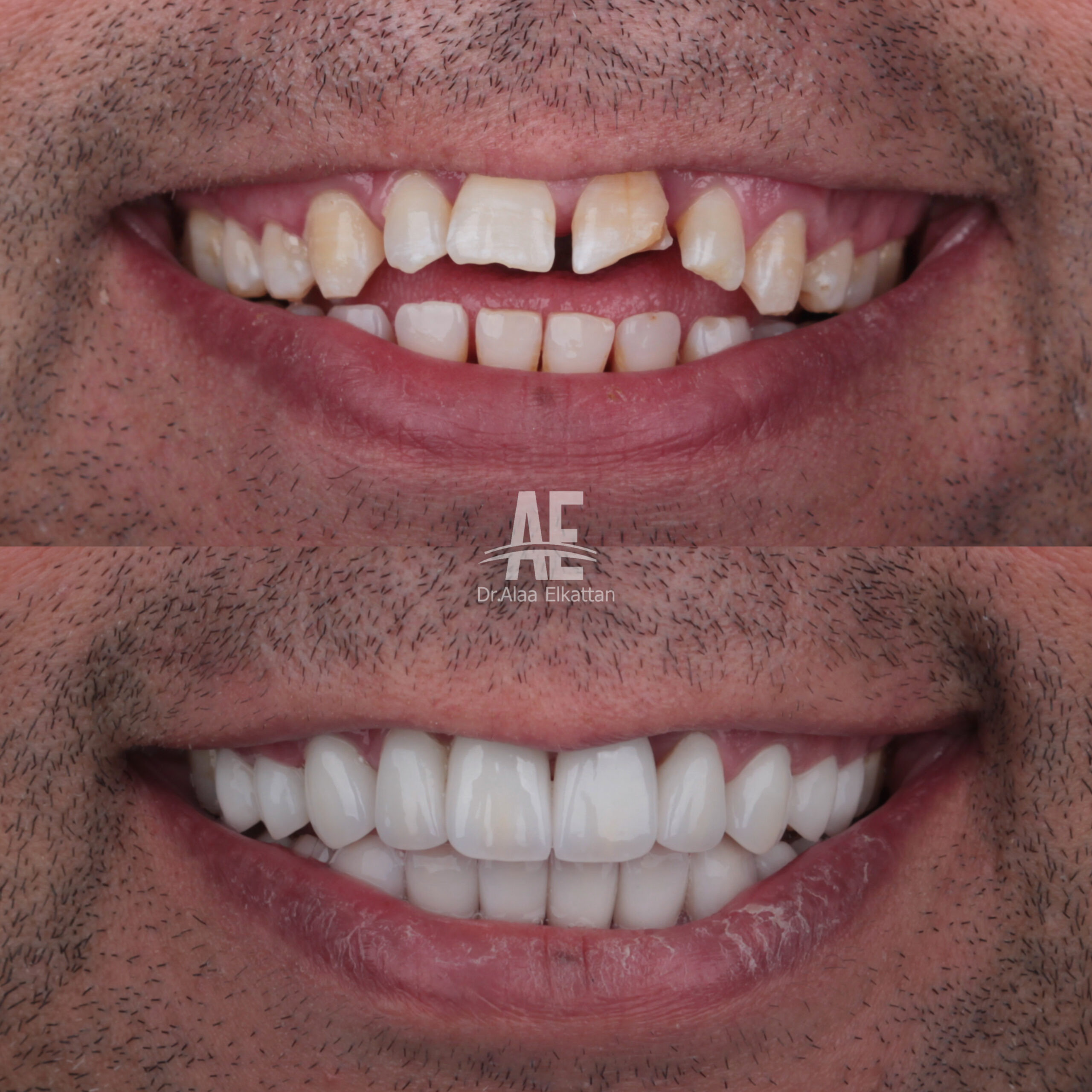 حالة موثقة 64 - Royal Dental Center