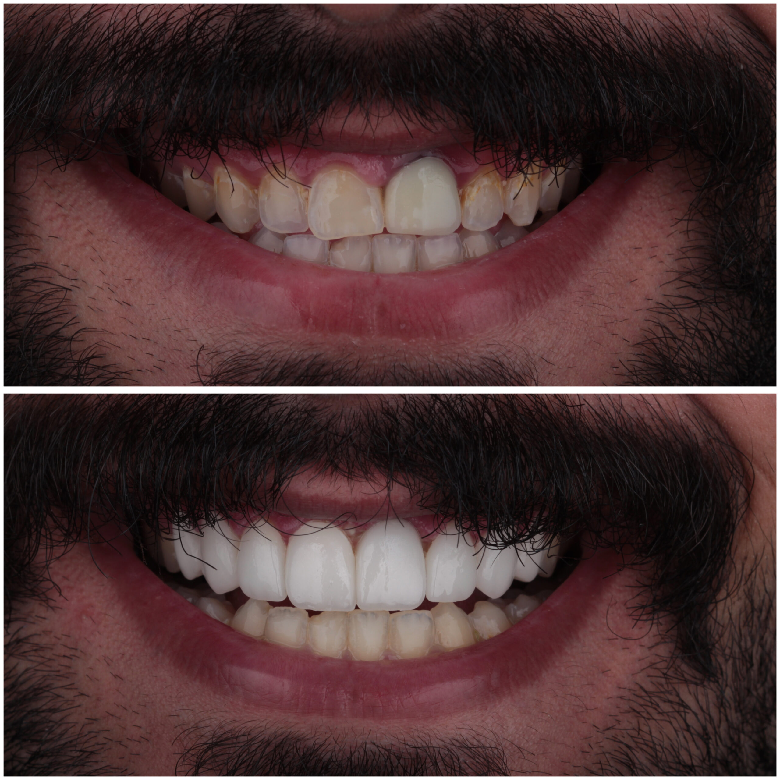 حالة موثقة 67 - Royal Dental Center