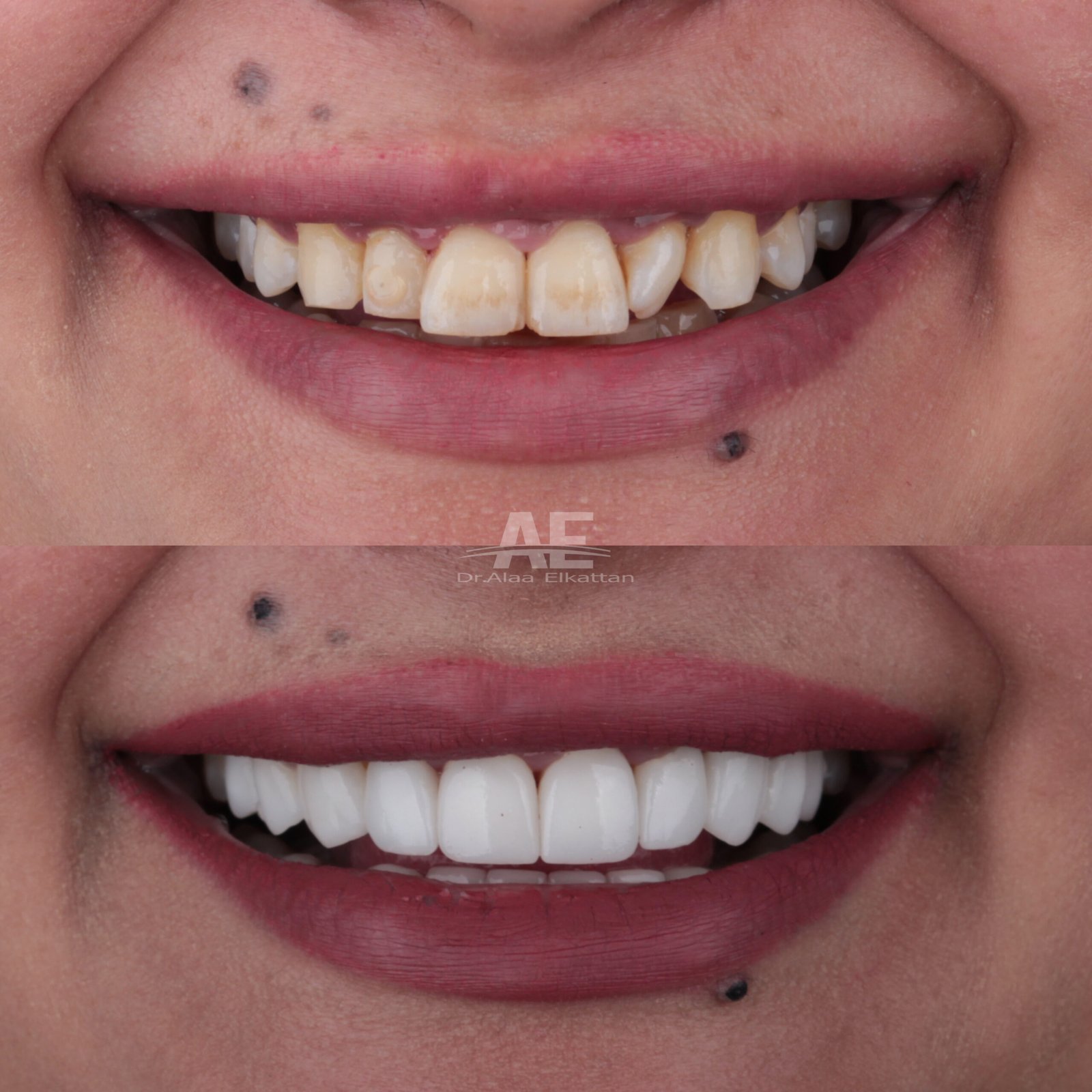 حالة موثقة 10 - Royal Dental Center