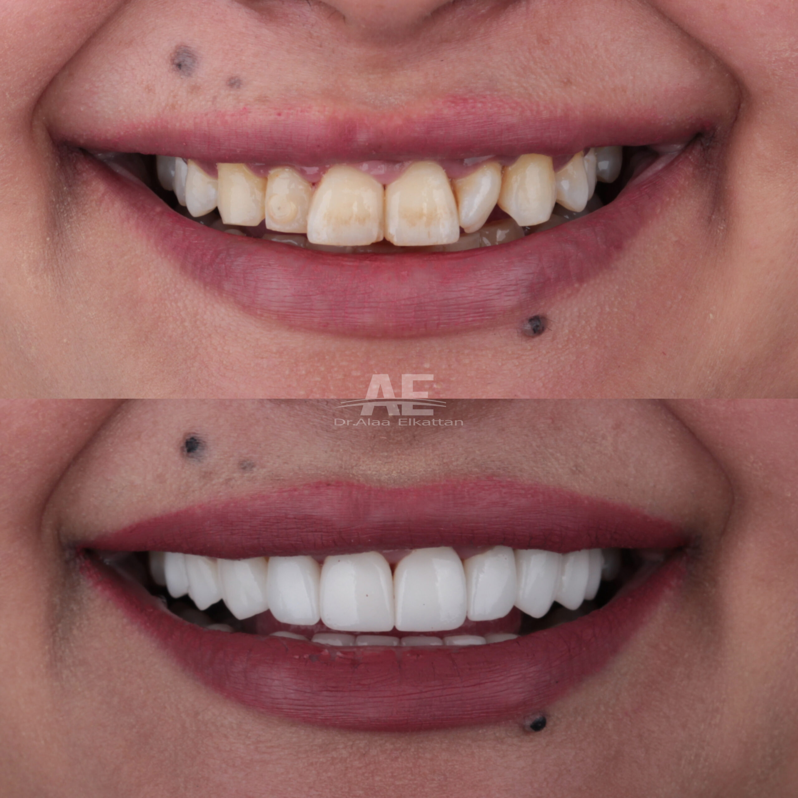 حالة موثقة 51 - Royal Dental Center