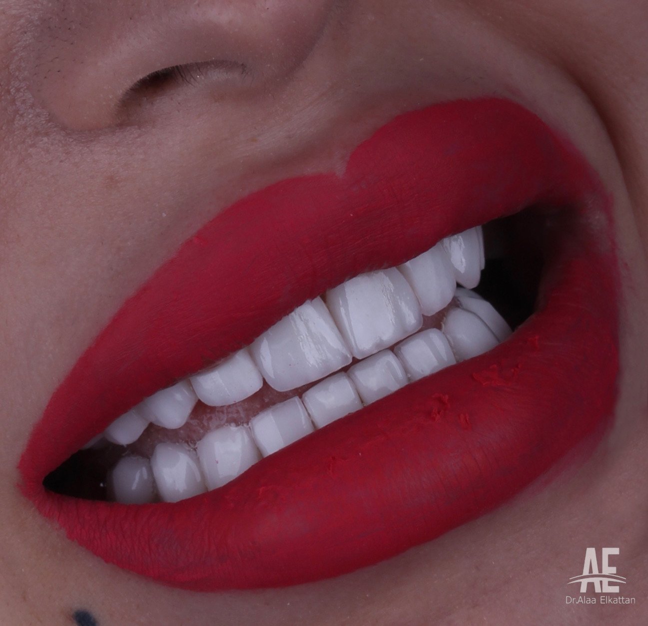 حالة موثقة 5 - Royal Dental Center