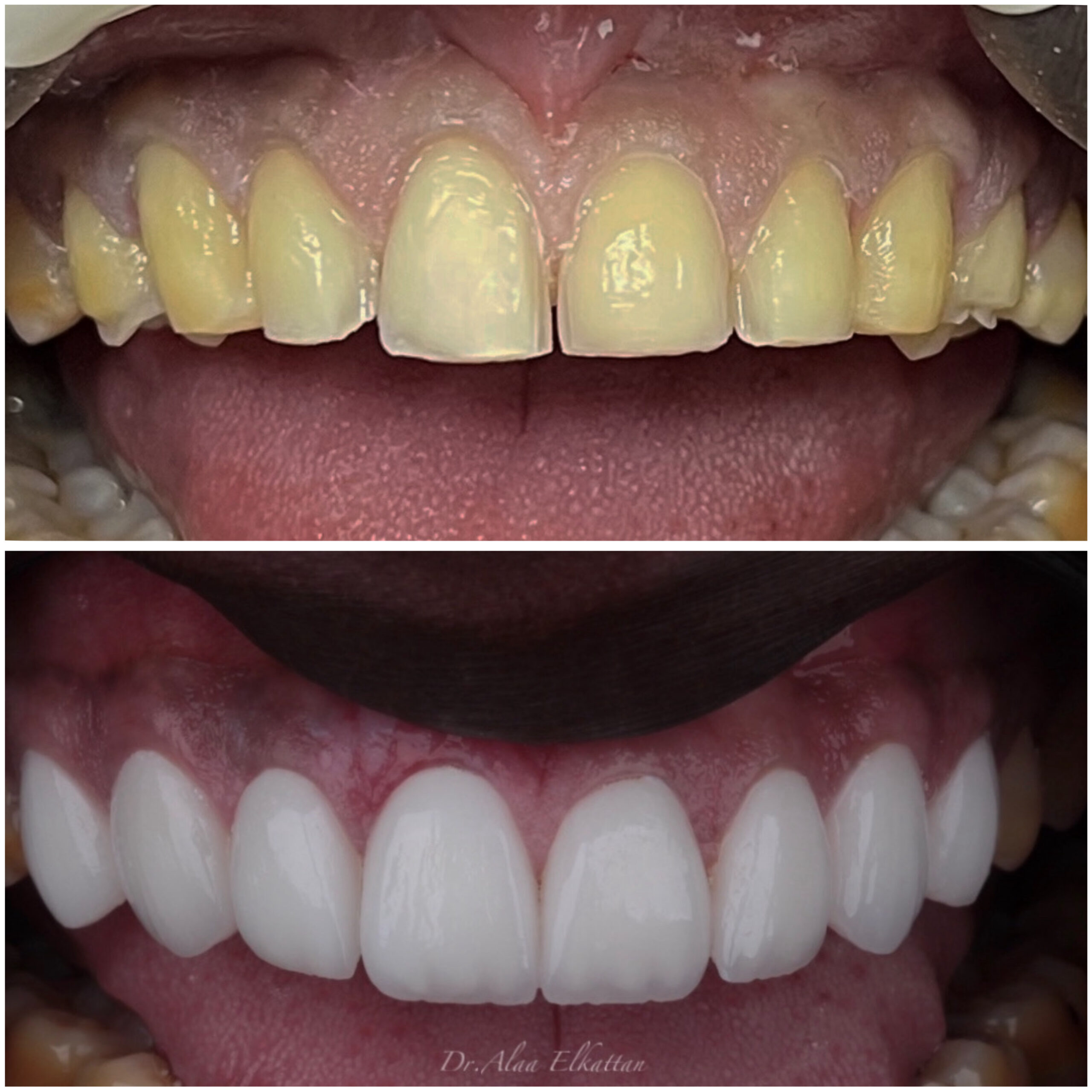 حالة موثقة 24 - Royal Dental Center
