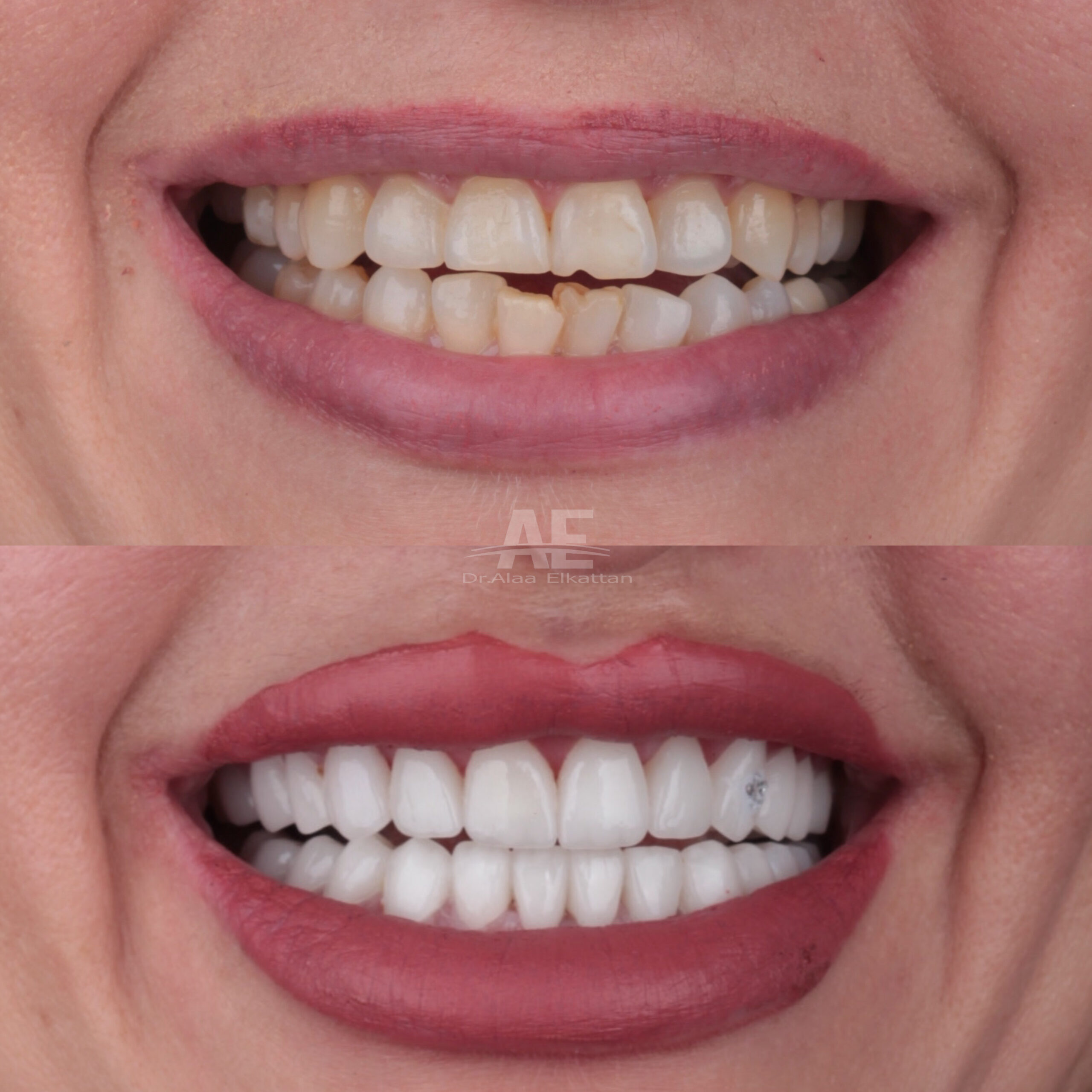 حالة موثقة 30 - Royal Dental Center