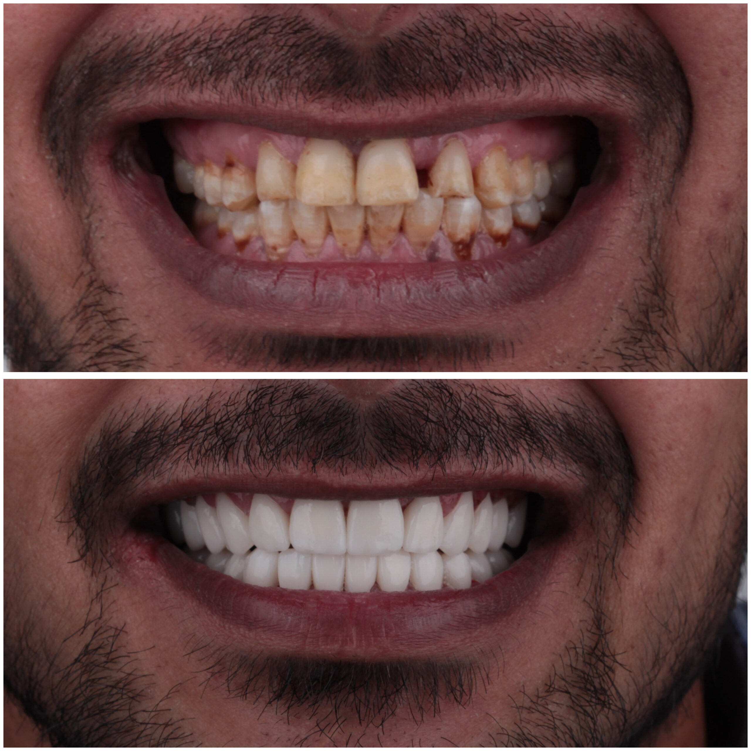 حالة موثقة 57 - Royal Dental Center