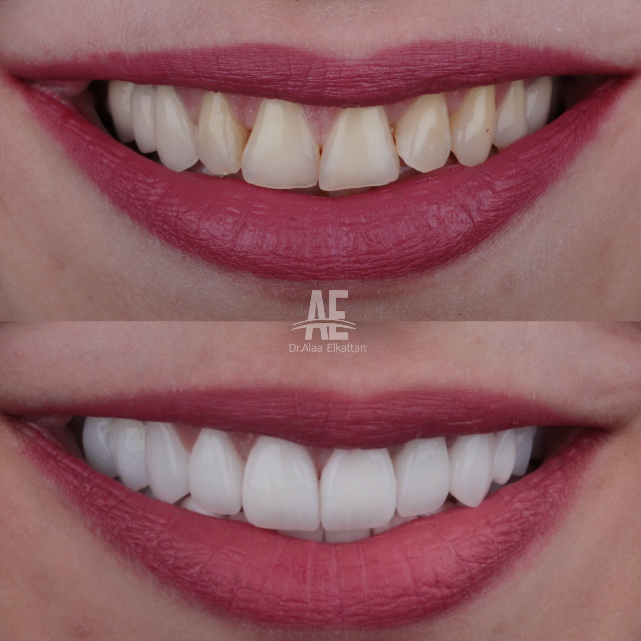 حالة موثقة 37 - Royal Dental Center