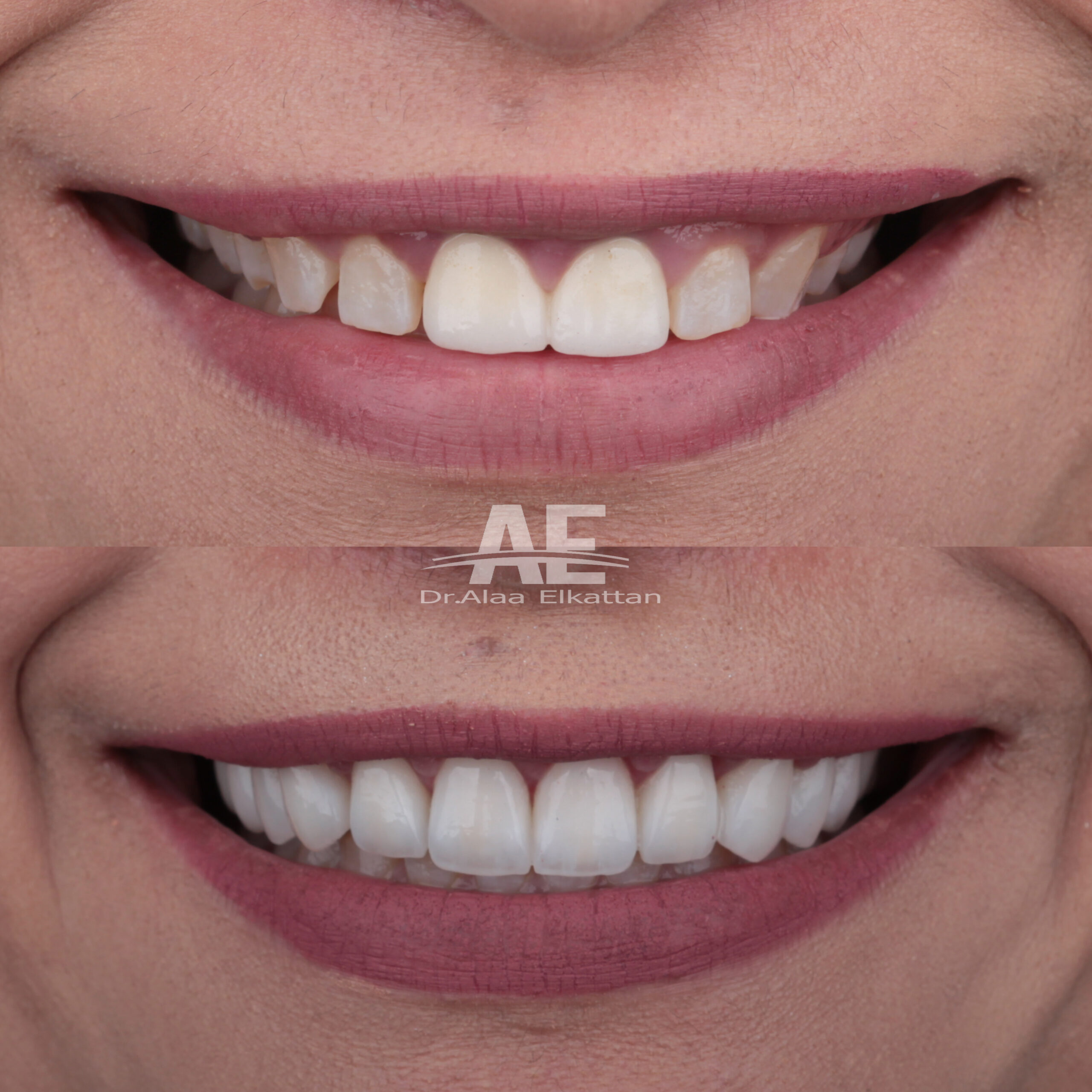 حالة موثقة 55 - Royal Dental Center