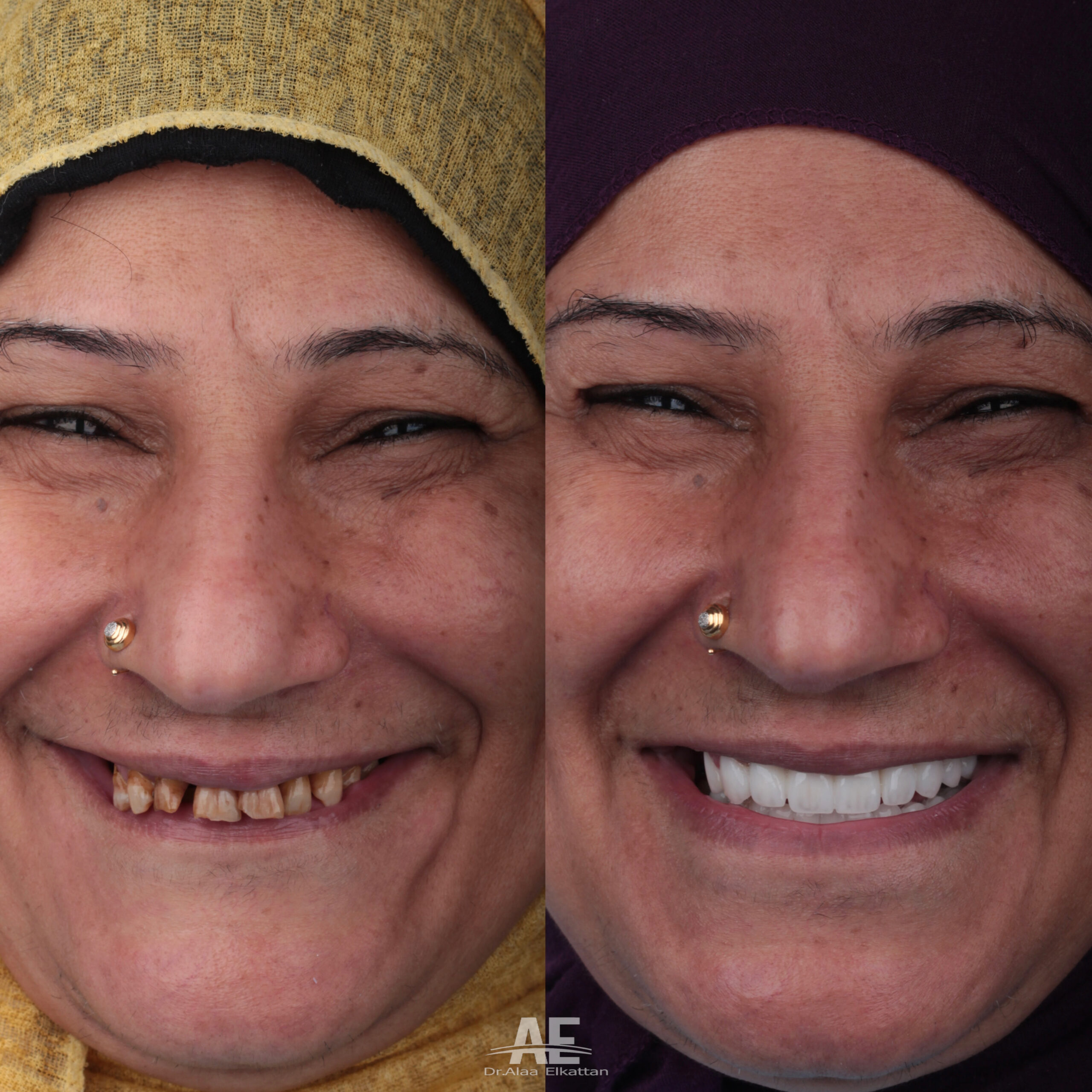 حالة موثقة 68 - Royal Dental Center