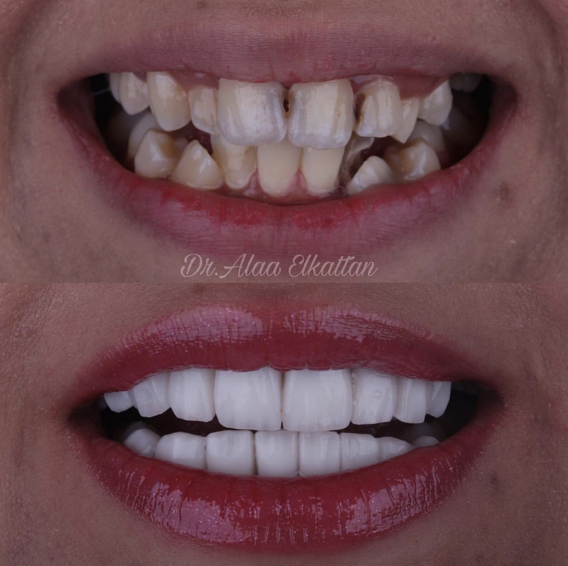 حالة موثقة 74 - Royal Dental Center