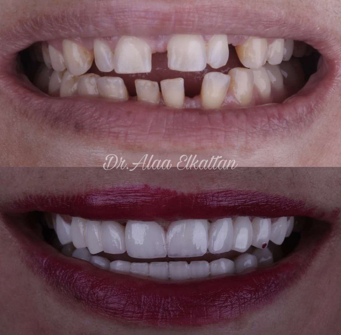 حالة موثقة 75 - Royal Dental Center