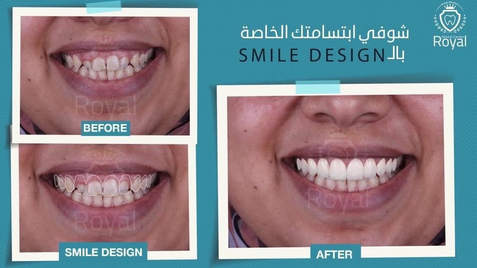 حالة فينير وابتسامة هوليوود 6 - د. علاء القطان