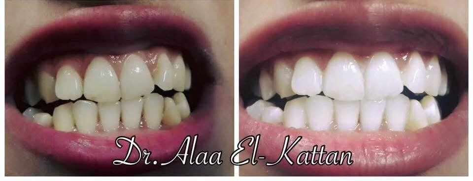 نتيجة تبييض أسنان - قبل