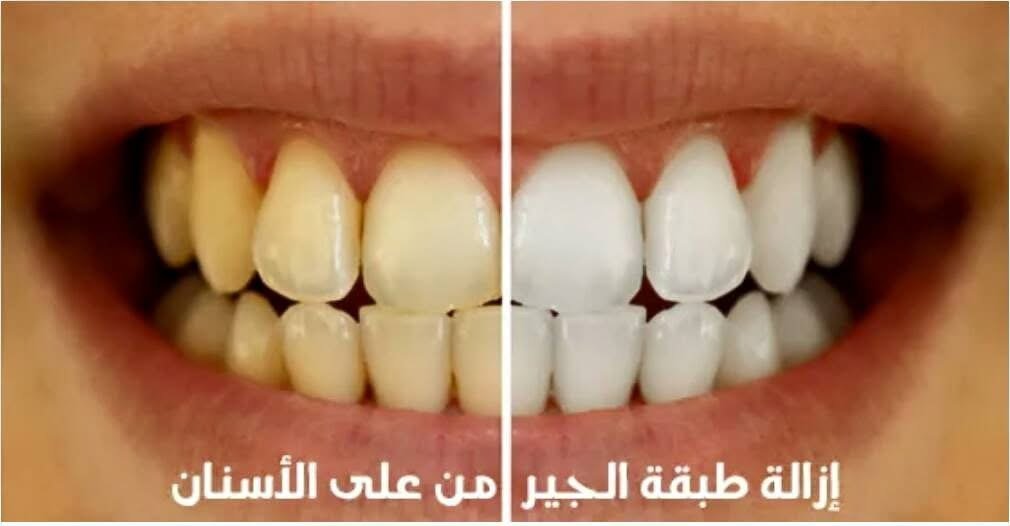 تنظيف الجير وتلميع الأسنان
