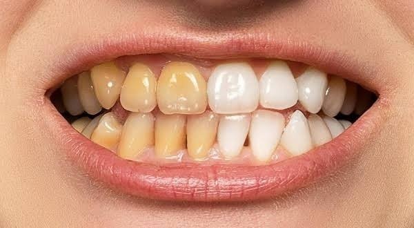 تبييض أسنان في العيادة