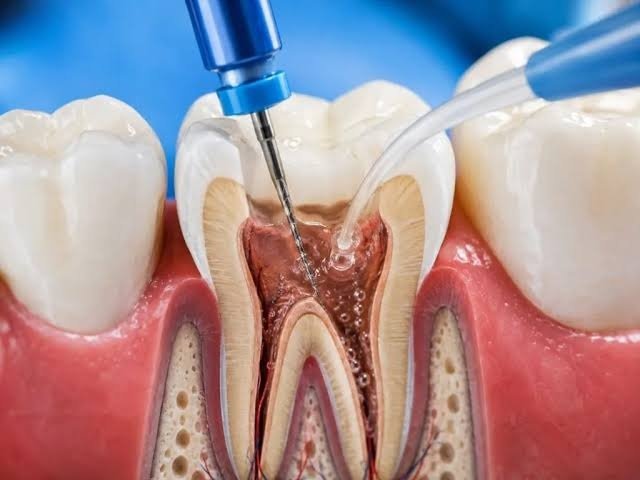 خطوات علاج العصب