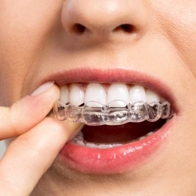 تقويم شفاف Invisalign