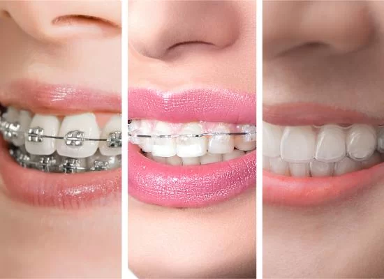 جميع أنواع تقويم الأسنان متوفرة في عيادة د. علاء القطان